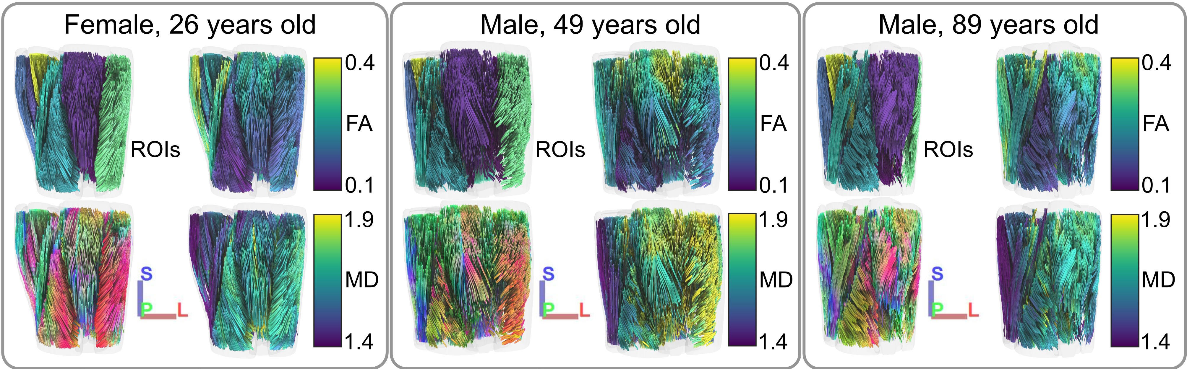 Muscle diffusion MRI in ageing
