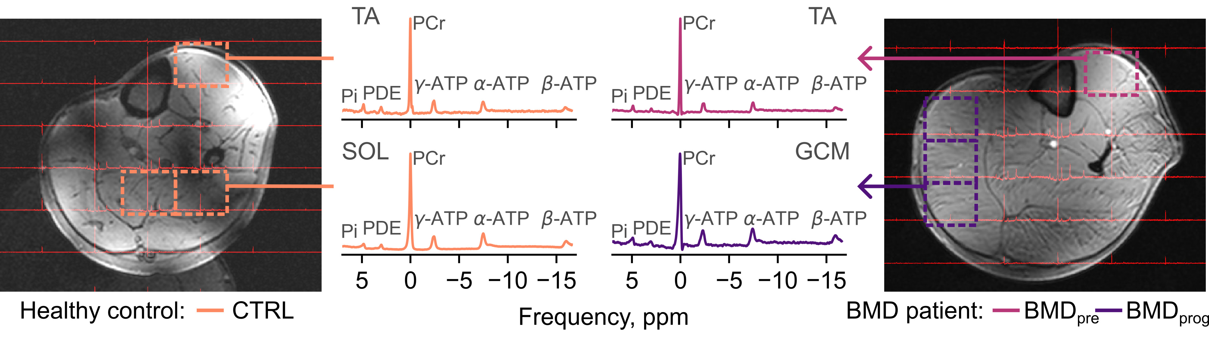 Phosphorus magnetic resonance in a Becker patient and a control